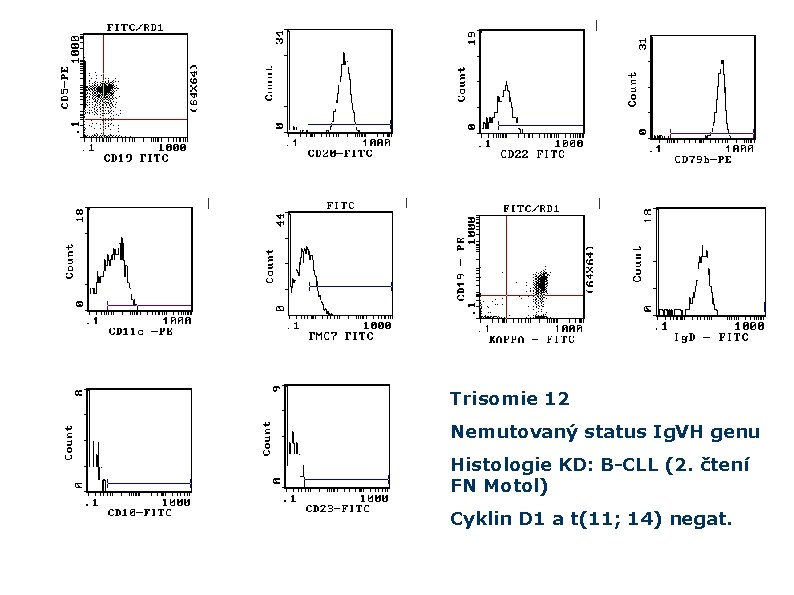 Trisomie 12 Nemutovaný status Ig. VH genu Histologie KD: B-CLL (2. čtení FN Motol)