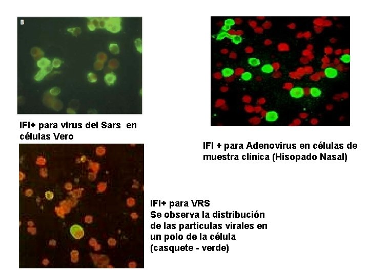 IFI+ para virus del Sars en células Vero IFI + para Adenovirus en células