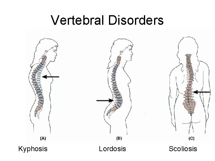 Vertebral Disorders Kyphosis Lordosis Scoliosis 