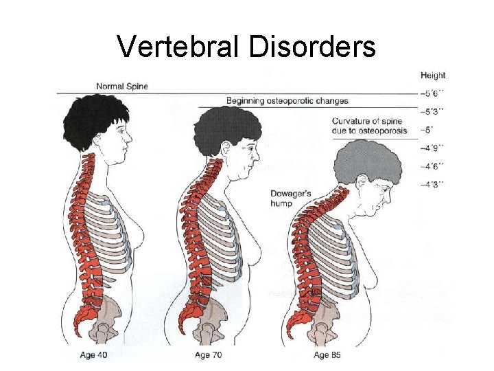 Vertebral Disorders 