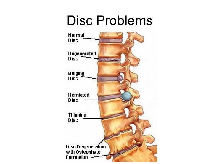 Disc Problems 