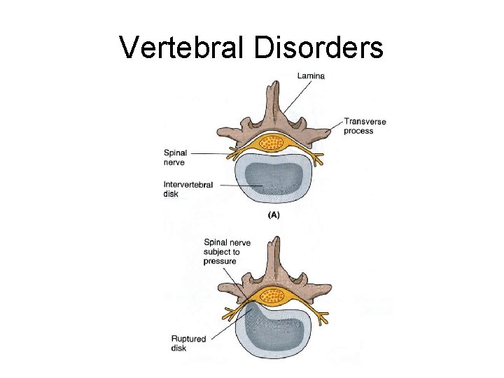 Vertebral Disorders 