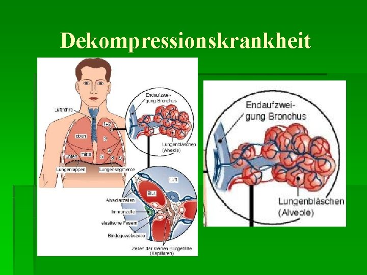 Dekompressionskrankheit 