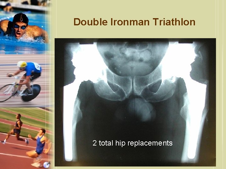 Double Ironman Triathlon 2 total hip replacements 