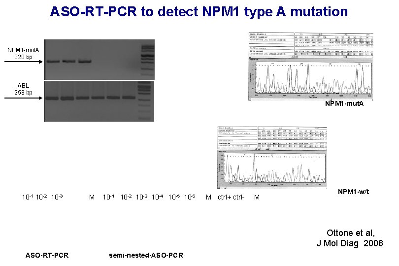 ASO-RT-PCR to detect NPM 1 type A mutation NPM 1 -mut. A 320 bp