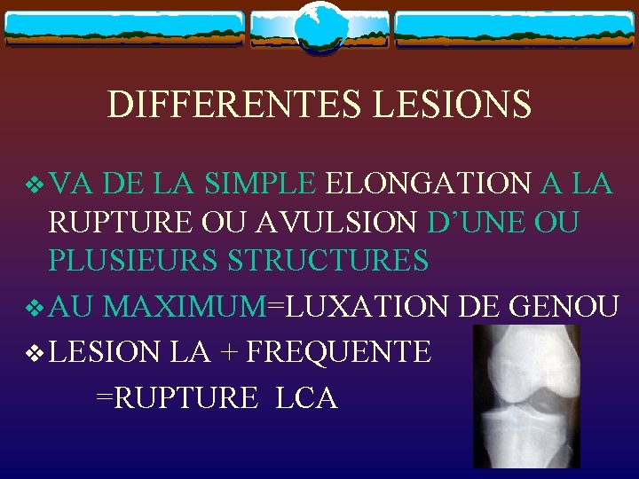 DIFFERENTES LESIONS v VA DE LA SIMPLE ELONGATION A LA RUPTURE OU AVULSION D’UNE