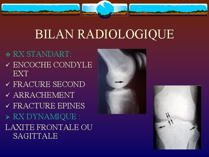 BILAN RADIOLOGIQUE RX STANDART: ü ENCOCHE CONDYLE EXT ü FRACURE SECOND ü ARRACHEMENT ü