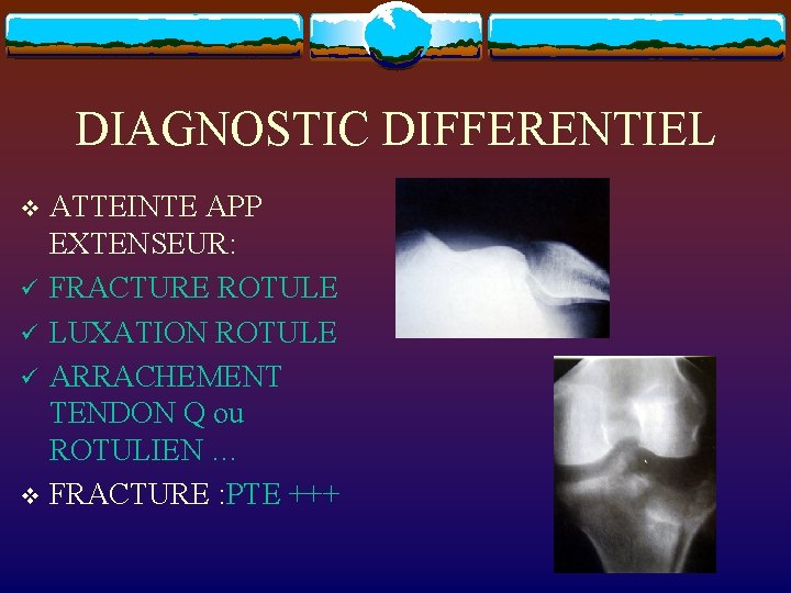 DIAGNOSTIC DIFFERENTIEL ATTEINTE APP EXTENSEUR: ü FRACTURE ROTULE ü LUXATION ROTULE ü ARRACHEMENT TENDON