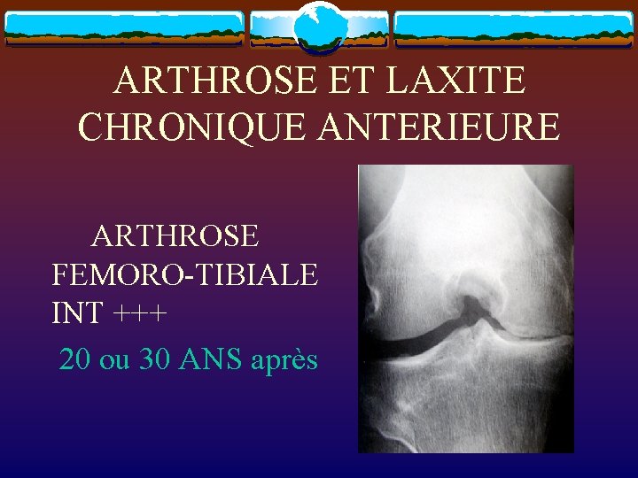 ARTHROSE ET LAXITE CHRONIQUE ANTERIEURE ARTHROSE FEMORO-TIBIALE INT +++ 20 ou 30 ANS après