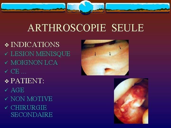 ARTHROSCOPIE SEULE v INDICATIONS ü ü ü LESION MENISQUE MOIGNON LCA CE … v