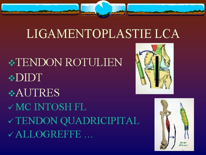 LIGAMENTOPLASTIE LCA v. TENDON ROTULIEN v. DIDT v. AUTRES ü MC INTOSH FL ü