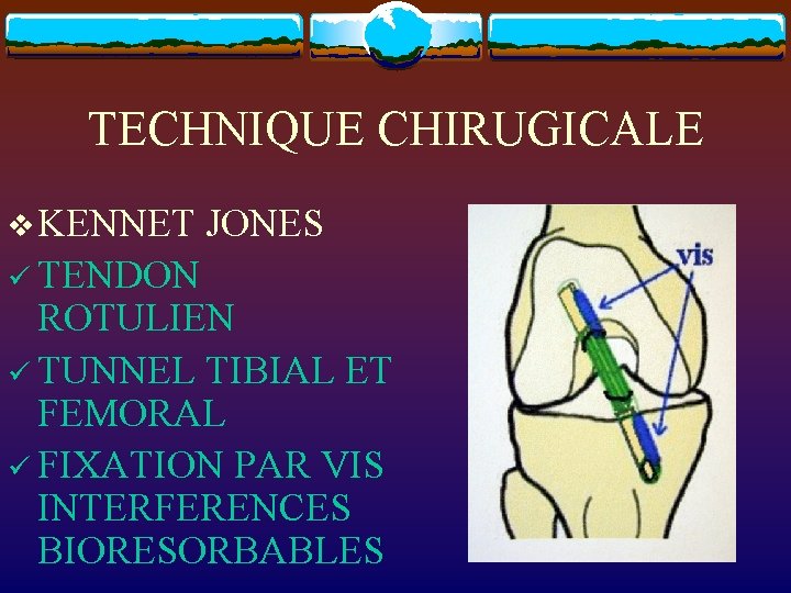 TECHNIQUE CHIRUGICALE v KENNET JONES ü TENDON ROTULIEN ü TUNNEL TIBIAL ET FEMORAL ü