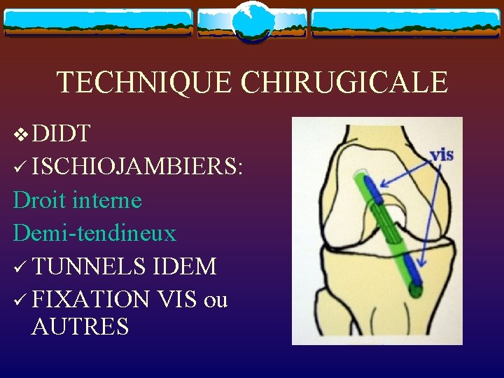 TECHNIQUE CHIRUGICALE v DIDT ü ISCHIOJAMBIERS: Droit interne Demi-tendineux ü TUNNELS IDEM ü FIXATION