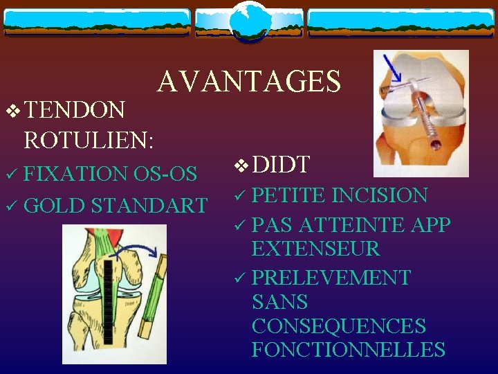 v TENDON AVANTAGES ROTULIEN: FIXATION OS-OS ü GOLD STANDART ü v DIDT PETITE INCISION