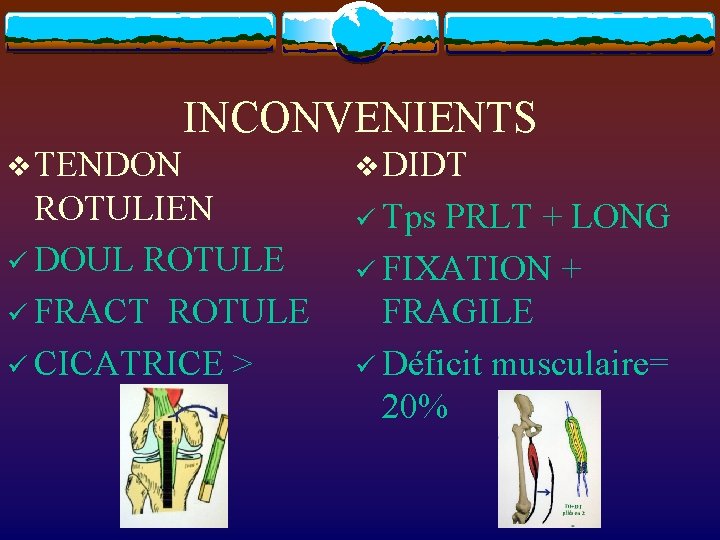 INCONVENIENTS v TENDON v DIDT ROTULIEN ü DOUL ROTULE ü FRACT ROTULE ü CICATRICE