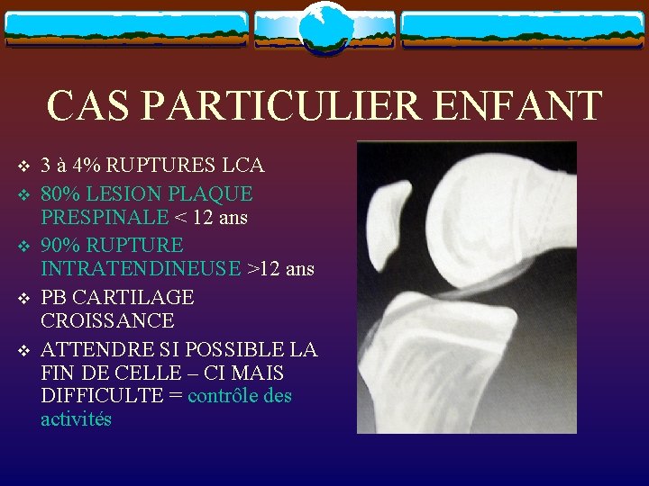 CAS PARTICULIER ENFANT v v v 3 à 4% RUPTURES LCA 80% LESION PLAQUE