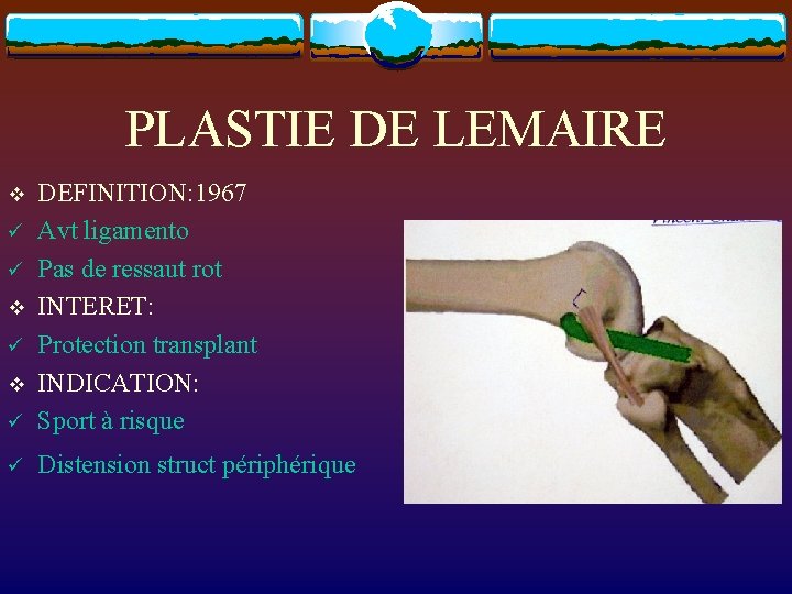 PLASTIE DE LEMAIRE ü DEFINITION: 1967 Avt ligamento Pas de ressaut rot INTERET: Protection