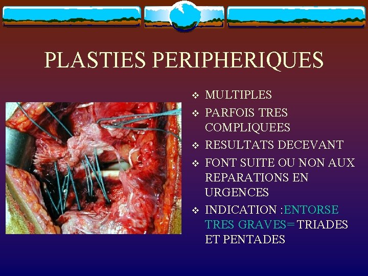 PLASTIES PERIPHERIQUES v v v MULTIPLES PARFOIS TRES COMPLIQUEES RESULTATS DECEVANT FONT SUITE OU