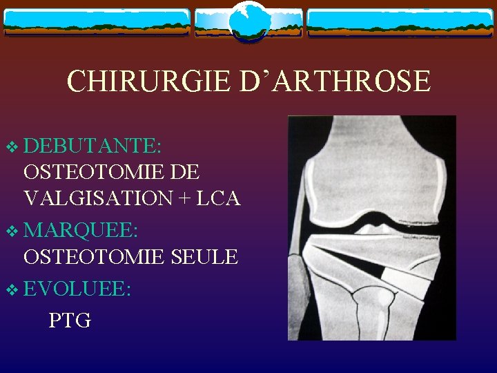 CHIRURGIE D’ARTHROSE v DEBUTANTE: OSTEOTOMIE DE VALGISATION + LCA v MARQUEE: OSTEOTOMIE SEULE v