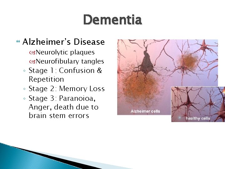 Dementia Alzheimer’s Disease Neurolytic plaques Neurofibulary tangles ◦ Stage 1: Confusion & Repetition ◦