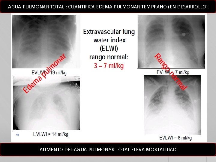 AGUA PULMONAR TOTAL : CUANTIFICA EDEMA PULMONAR TEMPRANO (EN DESARROLLO) AUMENTO DEL AGUA PULMONAR