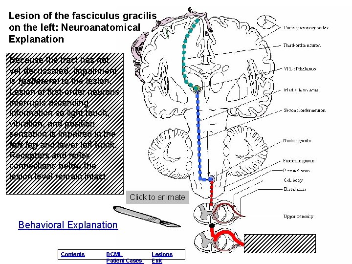 Lesion of the fasciculus gracilis on the left: Neuroanatomical Explanation Because the tract has