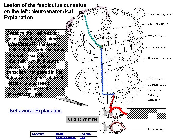 Lesion of the fasciculus cuneatus on the left: Neuroanatomical Explanation Because the tract has Lesion of the fasciculus cuneatus on the left: Neuroanatomical Explanation Because the tract has