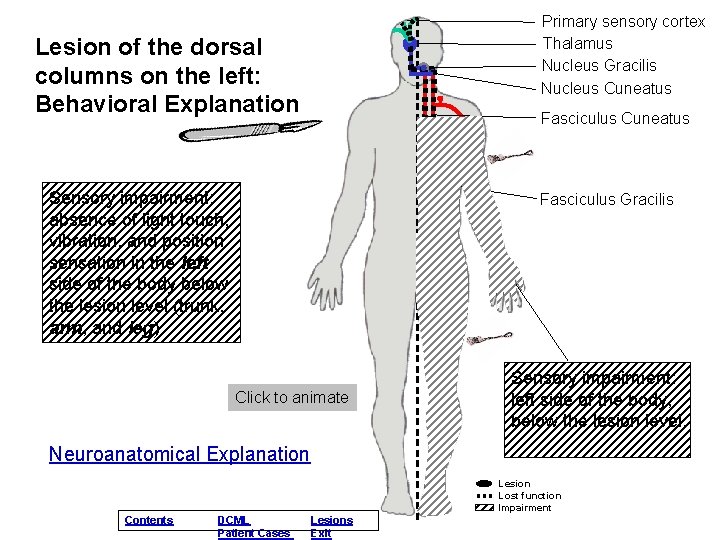 Primary sensory cortex Thalamus Nucleus Gracilis Nucleus Cuneatus Lesion of the dorsal columns on Primary sensory cortex Thalamus Nucleus Gracilis Nucleus Cuneatus Lesion of the dorsal columns on