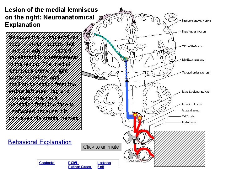 Lesion of the medial lemniscus on the right: Neuroanatomical Explanation Because the lesion involves Lesion of the medial lemniscus on the right: Neuroanatomical Explanation Because the lesion involves