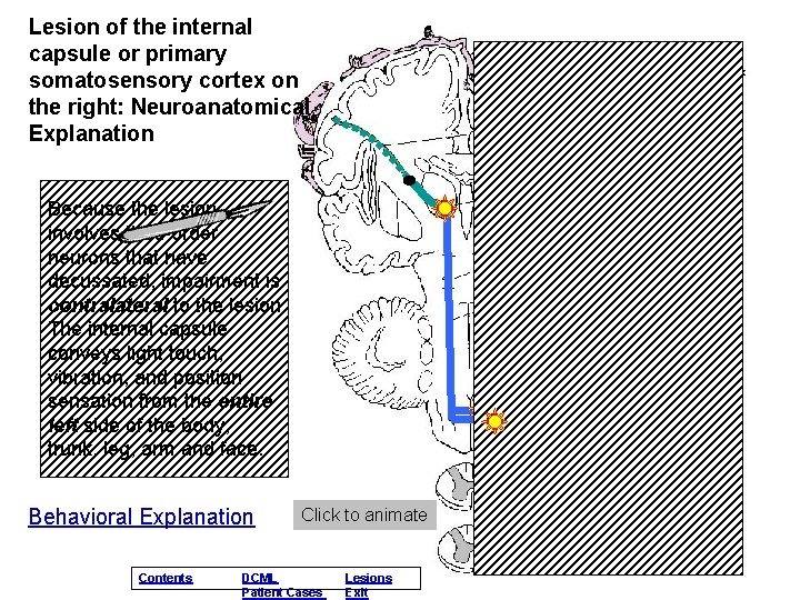 Lesion of the internal capsule or primary somatosensory cortex on the right: Neuroanatomical Explanation Lesion of the internal capsule or primary somatosensory cortex on the right: Neuroanatomical Explanation