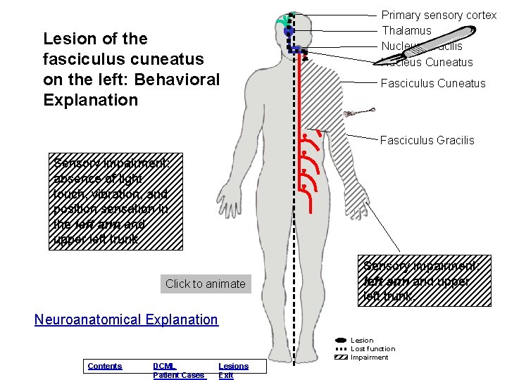 Lesion of the fasciculus cuneatus on the left: Behavioral Explanation Primary sensory cortex Thalamus Lesion of the fasciculus cuneatus on the left: Behavioral Explanation Primary sensory cortex Thalamus