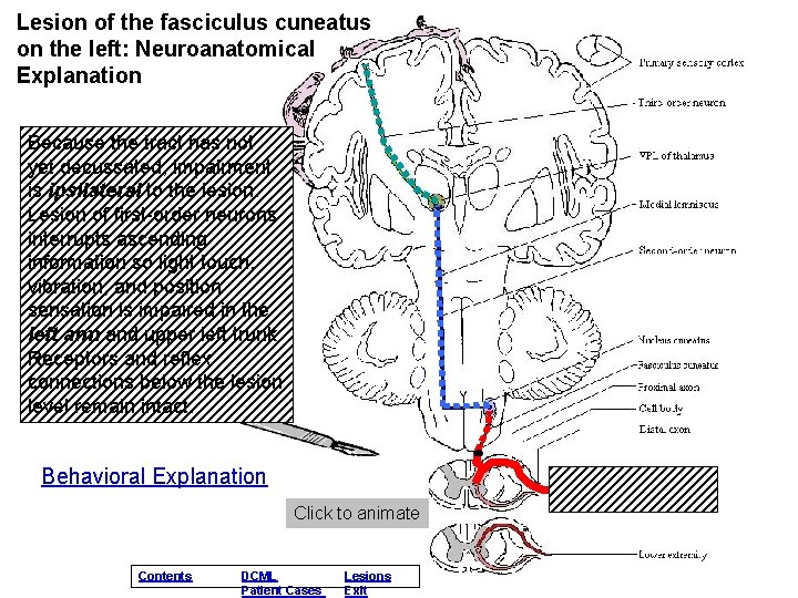 Lesion of the fasciculus cuneatus on the left: Neuroanatomical Explanation Because the tract has