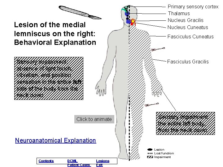Primary sensory cortex Thalamus Nucleus Gracilis Nucleus Cuneatus Lesion of the medial lemniscus on Primary sensory cortex Thalamus Nucleus Gracilis Nucleus Cuneatus Lesion of the medial lemniscus on