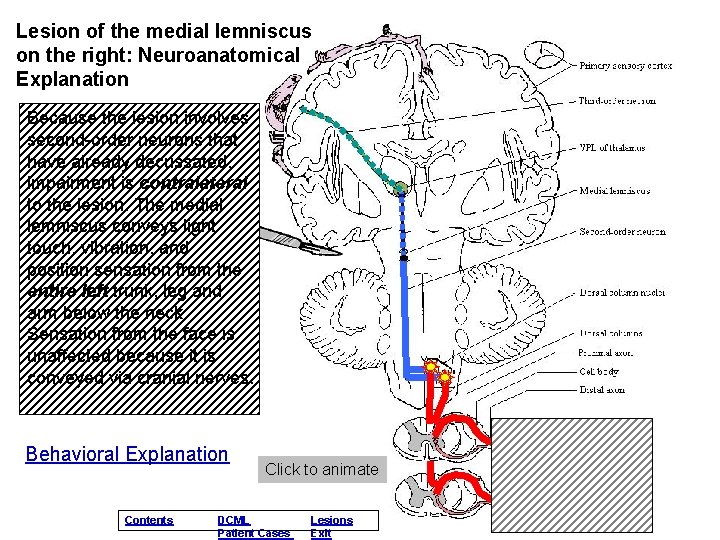 Lesion of the medial lemniscus on the right: Neuroanatomical Explanation Because the lesion involves