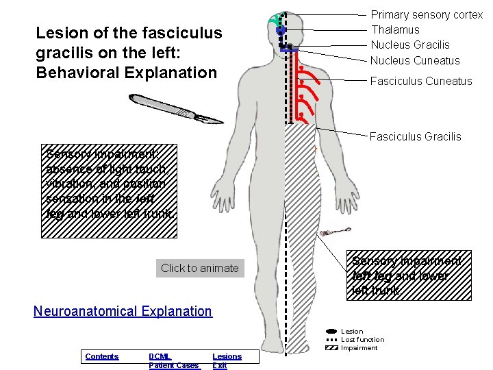 Lesion of the fasciculus gracilis on the left: Behavioral Explanation Primary sensory cortex Thalamus Lesion of the fasciculus gracilis on the left: Behavioral Explanation Primary sensory cortex Thalamus