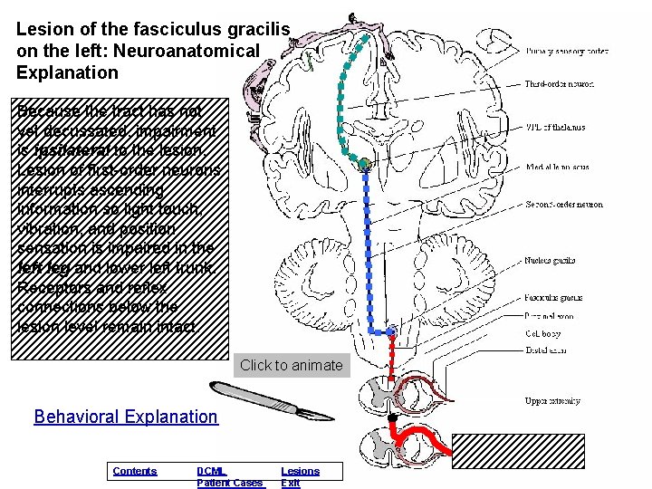 Lesion of the fasciculus gracilis on the left: Neuroanatomical Explanation Because the tract has Lesion of the fasciculus gracilis on the left: Neuroanatomical Explanation Because the tract has