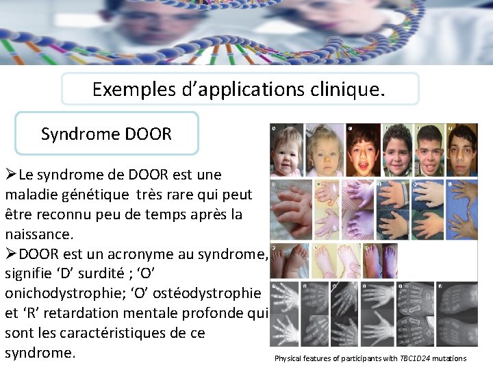 Exemples d’applications clinique. Syndrome DOOR ØLe syndrome de DOOR est une maladie génétique très