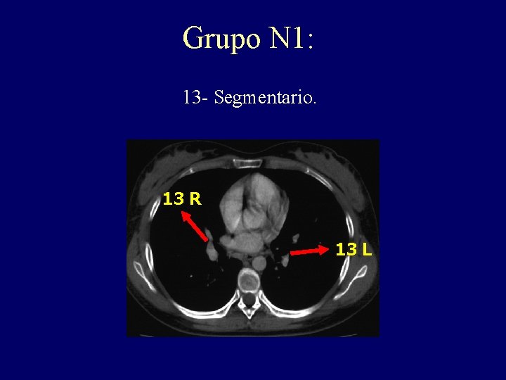 Grupo N 1: 13 - Segmentario. 13 R 13 L Grupo N 1: 13 - Segmentario. 13 R 13 L