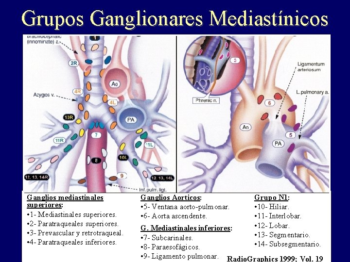 Grupos Ganglionares Mediastínicos Ganglios mediastinales superiores: • 1 - Mediastinales superiores. • 2 - Grupos Ganglionares Mediastínicos Ganglios mediastinales superiores: • 1 - Mediastinales superiores. • 2 -
