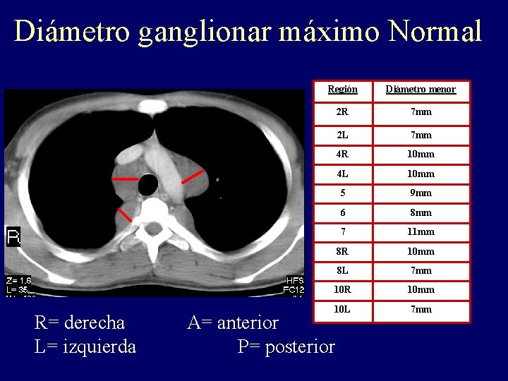 Diámetro ganglionar máximo Normal R= derecha L= izquierda Región Diámetro menor 2 R 7 Diámetro ganglionar máximo Normal R= derecha L= izquierda Región Diámetro menor 2 R 7