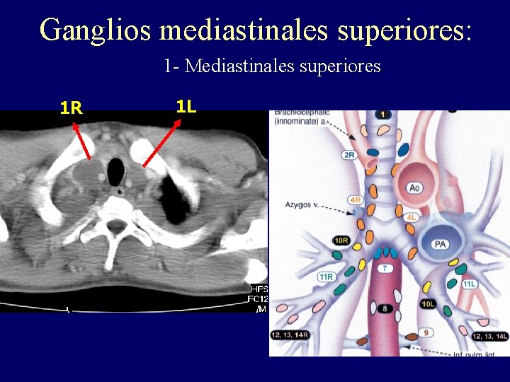 Ganglios mediastinales superiores: 1 - Mediastinales superiores. 1 R 1 L Ganglios mediastinales superiores: 1 - Mediastinales superiores. 1 R 1 L