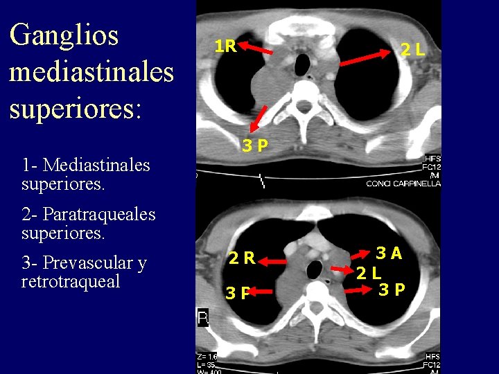 Ganglios mediastinales superiores: 1 - Mediastinales superiores. 1 R 2 L 3 P 2 Ganglios mediastinales superiores: 1 - Mediastinales superiores. 1 R 2 L 3 P 2