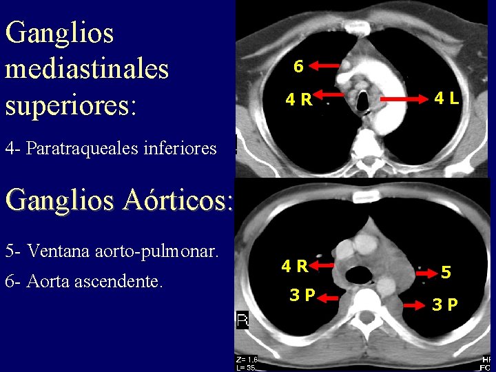 Ganglios mediastinales superiores: 6 4 R 4 L 4 R 5 4 - Paratraqueales Ganglios mediastinales superiores: 6 4 R 4 L 4 R 5 4 - Paratraqueales