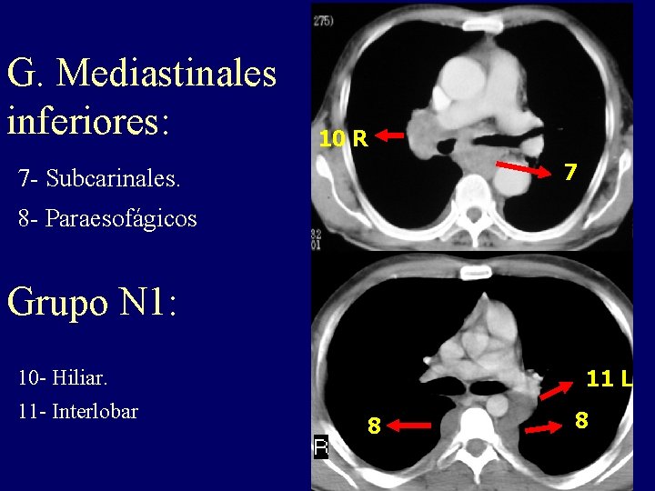 G. Mediastinales inferiores: 10 R 7 7 - Subcarinales. 8 - Paraesofágicos Grupo N G. Mediastinales inferiores: 10 R 7 7 - Subcarinales. 8 - Paraesofágicos Grupo N