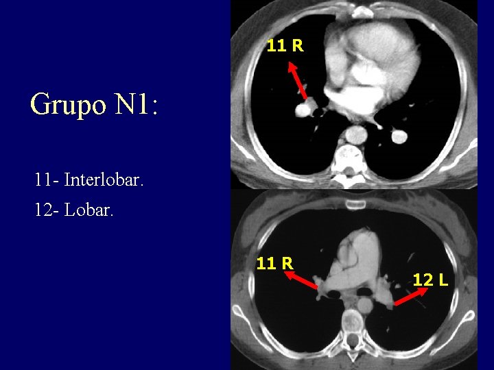 11 R Grupo N 1: 11 - Interlobar. 12 - Lobar. 11 R 12 11 R Grupo N 1: 11 - Interlobar. 12 - Lobar. 11 R 12