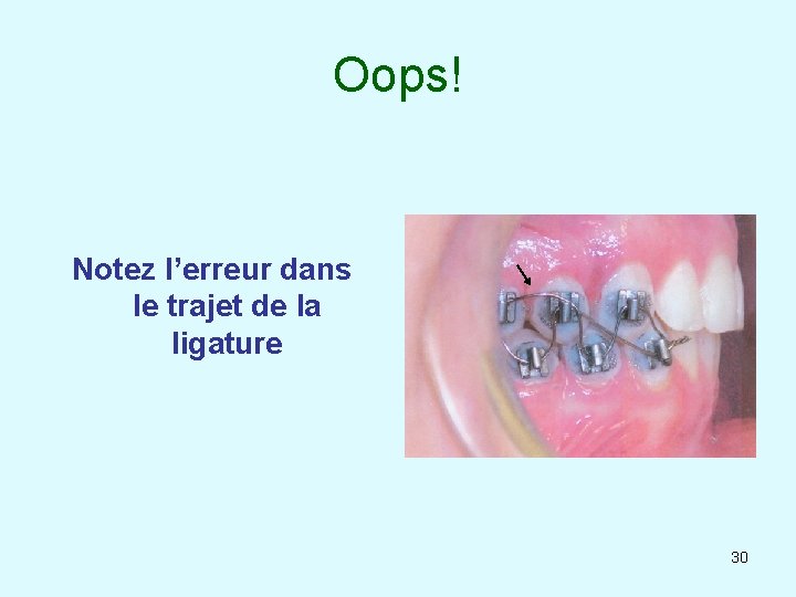 Oops! Notez l’erreur dans le trajet de la ligature 30 