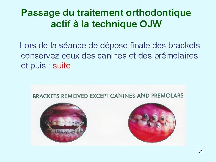 Passage du traitement orthodontique actif à la technique OJW Lors de la séance de