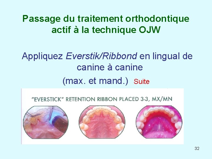 Passage du traitement orthodontique actif à la technique OJW Appliquez Everstik/Ribbond en lingual de