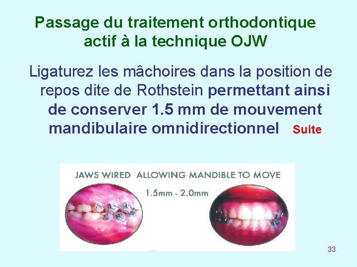 Passage du traitement orthodontique actif à la technique OJW Ligaturez les mâchoires dans la