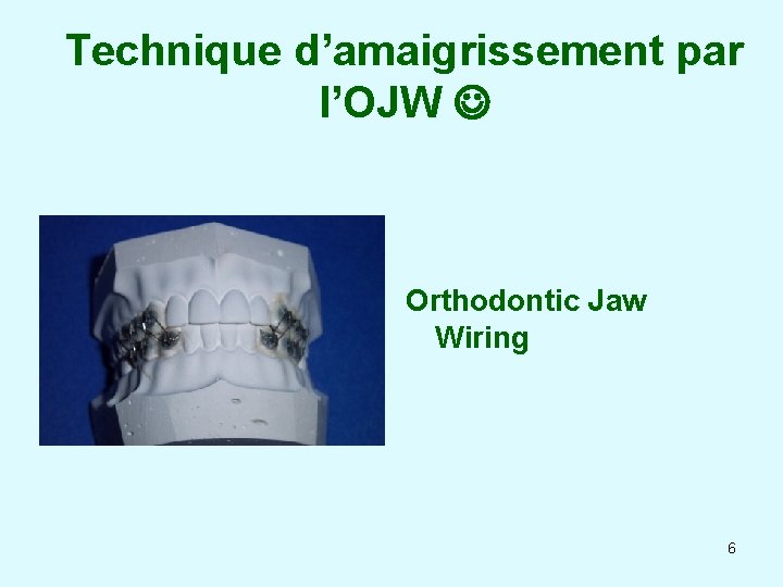 Technique d’amaigrissement par l’OJW Orthodontic Jaw Wiring 6 